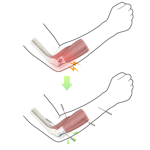 테니스엘보 한의학 치료 효과 기전 설명 일러스트