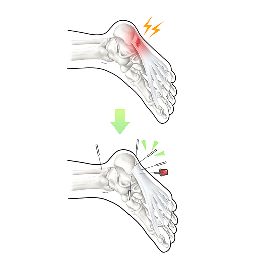 족저근막염 한의학 치료 효과 기전 설명 일러스트