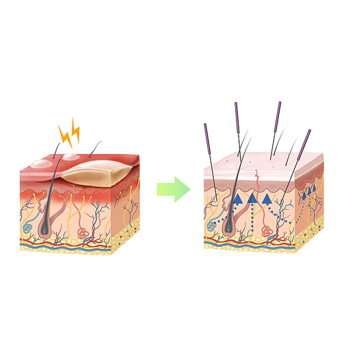 화상 침 한의학 치료 효과 기전 설명 일러스트