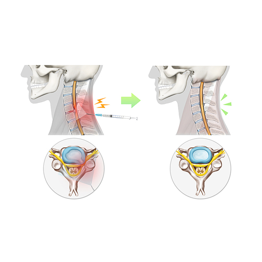 경추디스크 목디스크 봉침 약침 한의학 치료 효과 기전 설명 일러스트