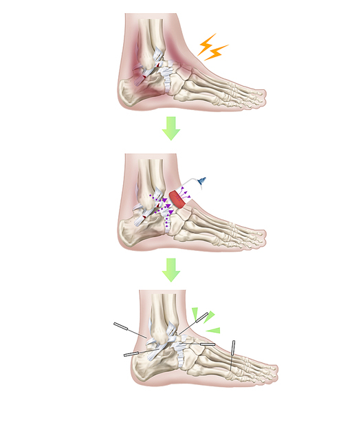 발목염좌 침 부항 한의학 치료 효과 기전 설명 일러스트