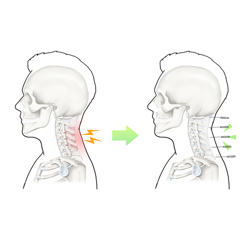 경추염좌 침 한의학 치료 효과 기전 설명 일러스트