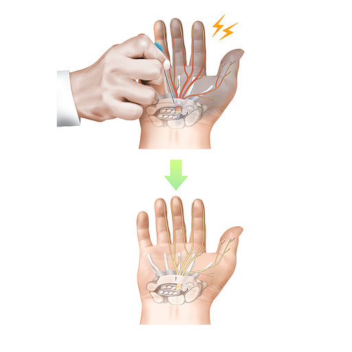 손목터널증후군 도침 한의학 치료 효과 기전 설명 일러스트