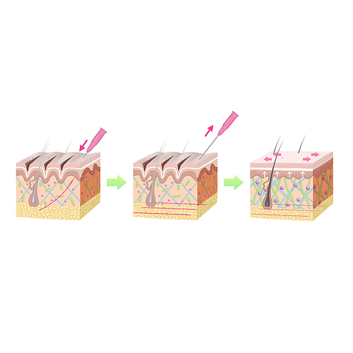 매선 피부미용 주름개선 한의학 치료 효과 기전 설명 일러스트