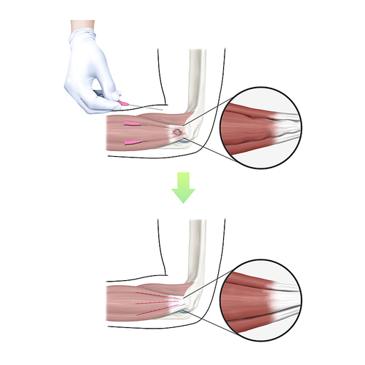 테니스엘보 매선 한의학 치료 효과 기전 설명 일러스트