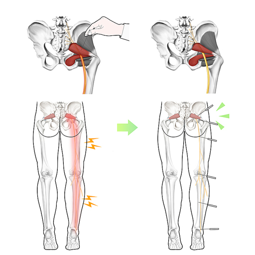 좌골신경통 침 한의학 치료 효과 기전 설명 일러스트