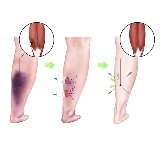 비복근파열 한의학 치료 효과 기전 설명 일러스트