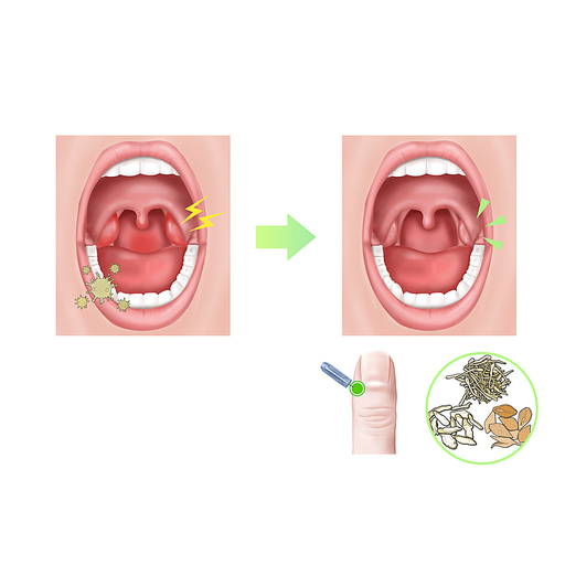 편도염 한의학 치료 효과 기전 설명 일러스트