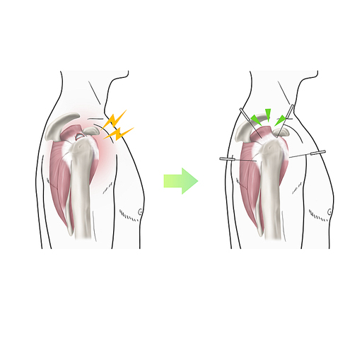 회전근개파열 침 한의학 치료 효과 기전 설명 일러스트