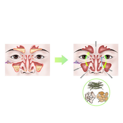 부비동염 한약 한의학 치료 효과 기전 설명 일러스트