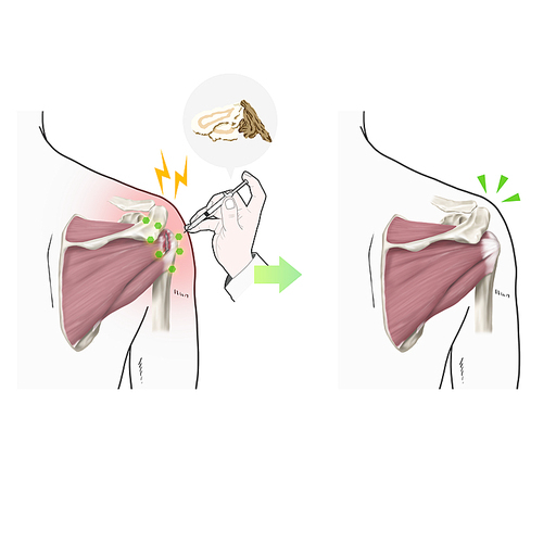 회전근개파열 약침 한의학 치료 효과 기전 설명 일러스트