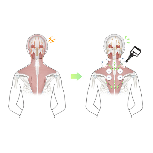 후두신경통 부항 한의학 치료 효과 기전 설명 일러스트
