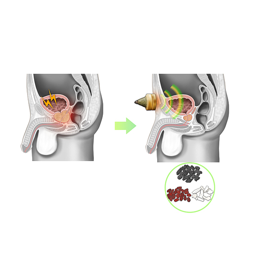 전립선비대증 한약 뜸 한의학 치료 효과 기전 설명 일러스트
