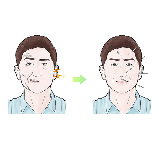 안면신경마비 침 한의학 치료 효과 기전 설명 일러스트