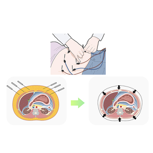 복부비만 전침 한의학 치료 효과 기전 설명 일러스트