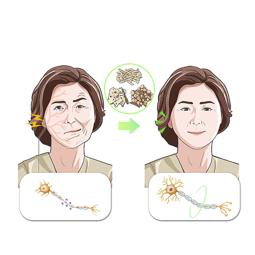 안면신경마비 구안와사 한약 한의학 치료 효과 기전 설명 일러스트