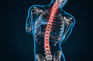 Spondylosis and Scoliosis. 3D illustration. Contains clipping path