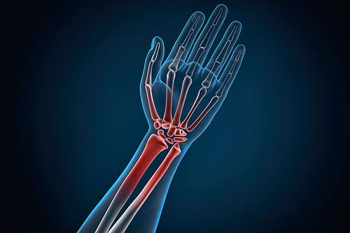 Human hand and wrist pain caused by arthritis. 3D illustration. Contains clipping path