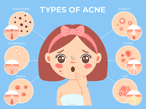 Girl with acne. Young unhappy female face with skin problems and pimple types icons. Dermatology and cosmetic skin care vector infographic with whiteheads and blackheads, pustules and nodule