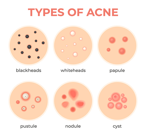 Acne types. Skin infection problem, pimples grade and type cyst, whitehead, blackheads, nodule and cystic. Dermis pore disease vector set. Facial inflammation, medical treatment and healthcare