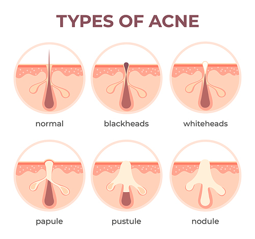 Acne types anatomy. Pimple diseases sectional view blackhead, cystic and whitehead. Structure of skin and pore infection vector infographic. Open and closed comedones. Medical disease