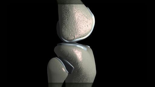 사람의 관절 뼈와 연골이 마모되는 과정을 컴퓨터 그래픽으로 표현한 CG 영상