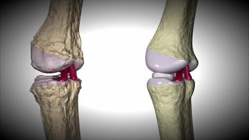 손상된 관절 뼈와 정상 관절 뼈 비교 그래픽, 인공 관절을 손상된 관절에 삽입하는 CG 영상