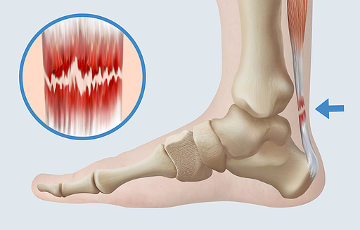 발 사진 위에 발뼈 그리고 발목뼈와 아킬레스건을 그려 넣은 의료 해부학 일러스트. 아킬레스건 파열
