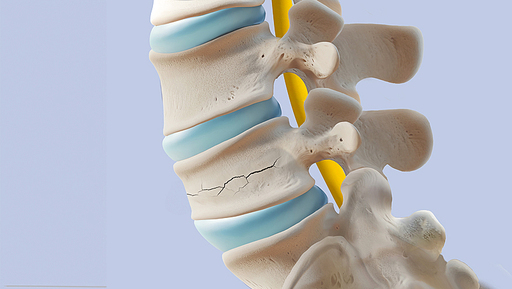 척추 압박 골절 해부학 일러스트