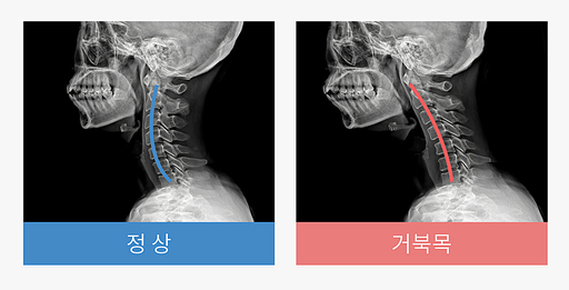 정상 목 엑스레이와 거북목 엑스레이 비교