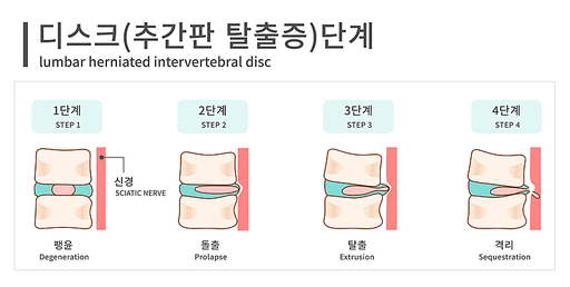 디스크(추간판탈출증)단계 일러스트 | 유토이미지 | 상세페이지 | 베이직샵 | 일러스트 | 22755369